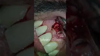 Dr. Johnny Alberto Onori #1 Apicoetomy