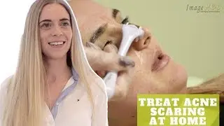 Get Rid Of Acne Scaring QUICKLY! - Derma Rolling With Acne Scars