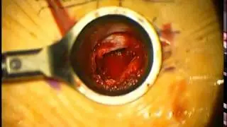 Minimally invasive TLIF_Banana Cage Insertion Technique