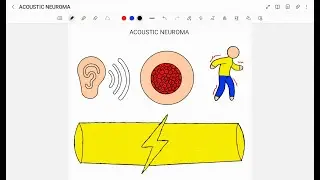 ACOUSTIC NEUROMA