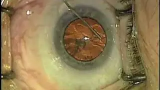 Chirurgie de la cataracte: haute efficacité par Dr. Shawn Cohen