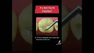 Вот почему раскололся твой леченый зуб!