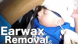 This is How to Remove Earwax from Junior's Ear