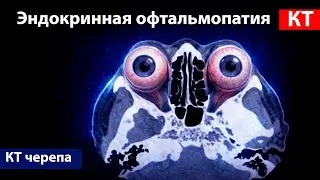 Radiological diagnostics of endocrine ophthalmopathy