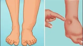 Ayak şişlikleri ve ödem