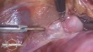 The importance of hemostasis and exposure of structures in a TLH