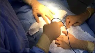 Miomectomía - Extirpación de miomas