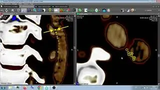 АРТЕРИОВЕНОЗНАЯ ФИСТУЛА ? ARTERIOVENOUS FISTULA ?