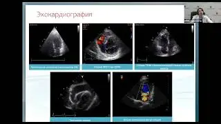 ОСН и кардиогенный шок при ОИМ Жаровин И.Н.