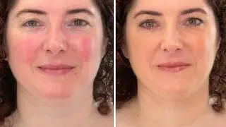 COMO CORREGIR ROJECES (ROSÁCEA) CON MAQUILLAJE