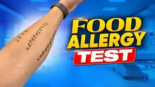 Food Allergy Test (Skin) | My Experience #foodallergytest