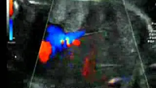 Ductus Venoso drenando directamente en la Vena Cava Inferior