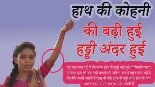 हाथ की कोहनी की बढ़ी हुई हड्डी अंदर हुईं