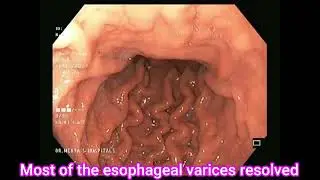 Post banding endoscopy for esophageal varices| Portal hypertension| Dr. Pandiaraja| Surgeon