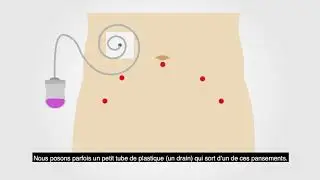 Prostatectomy - Module 1