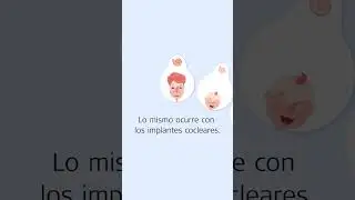 ¿Qué es un implante coclear personalizado? | 