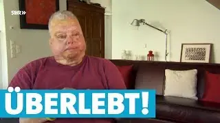 Bernhard überlebt Flugzeug-Explosion trotz schwerer Verbrennungen