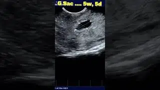 Miscarriage at 6wks - Ultrasound | No need to Follow-up !!