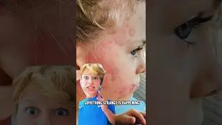 Brother's Strange Rash on face. What is it? 