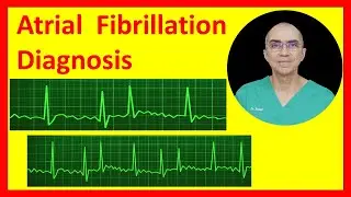 Atrial Fibrillation Diagnosis