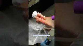 Удаление родинки на стопе 