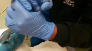Getting My Arm Cast Off