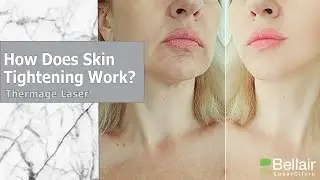 What is Thermage skin tightening?