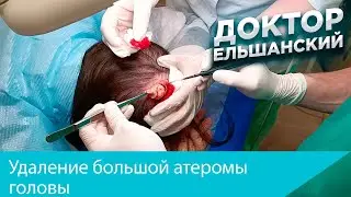 Удаление большой атеромы головы