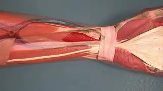 Wrist Plate Removal and External Fixation