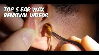 5 Awesome Tips to Remove Ear Wax