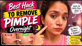 How to remove pimples overnight. Best and Cheapest hack