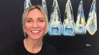 Myth: Root canals are painful
