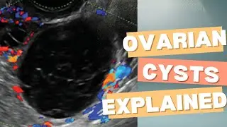 Ovarian Cysts: Sonographic Findings, Etiology & Clinical Insights