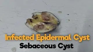 Infected Epidermal Cyst / Sebaceous Cyst Dissection