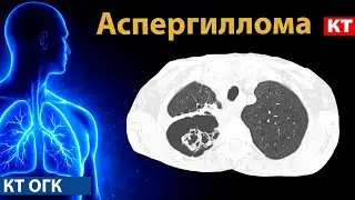 Radiological diagnostics of aspergillosis