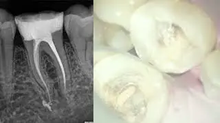 Mandibular Molar Obturation with Bio ceramic Sealer