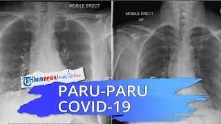 Pentingnya Vaksin, Dokter Bandingkan Rontgen Paru-paru Pasien Covid-19 yang Sudah Divaksin dan Belum