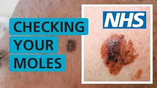 How do I check if my mole is skin cancer? | NHS