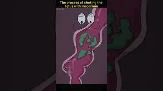 Fetus with meconium