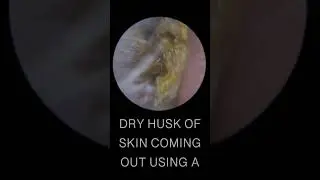 DRY EAR WAX HUSK REMOVAL