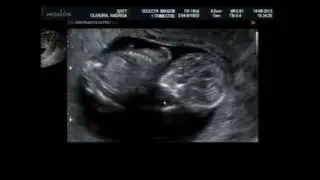 Ultrassom 12 semanas