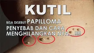 Apa itu KUTIL ??? - Jenis Kutil dan Cara Mengatasinya