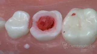 How to do a pulpotomy