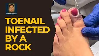 Severely Infected Toe from a ROCK