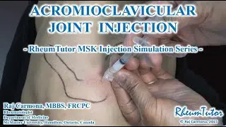 Acromioclavicular Joint Injection