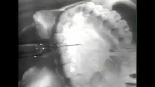 44 Anterior Palatine Nerve Block cassette only
