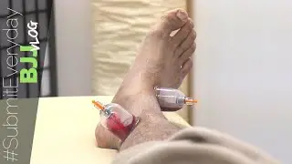 Cupping for Ankle Recovery at HijamahWorks | #SubmitEveryday BJJ Vlog