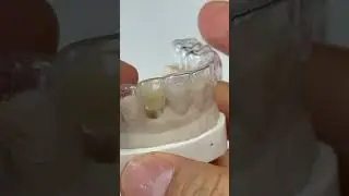 Stent with one tooth
