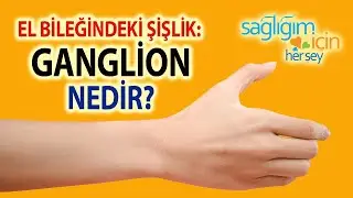 El Bileğindeki Şişlik: Ganglion Nedir?