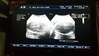 Janin Bayi Kembar Umur 34 Minggu